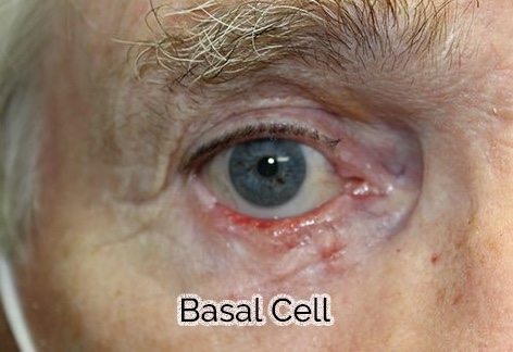 Total Lower Eyelid Reconstruction After Skin Cancer Removal