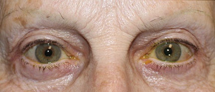 Ptosis repair on upper eyelids. After