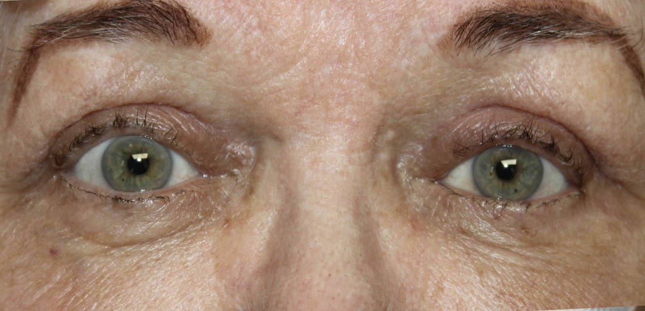 Upper Eyelid External Ptosis Repair After