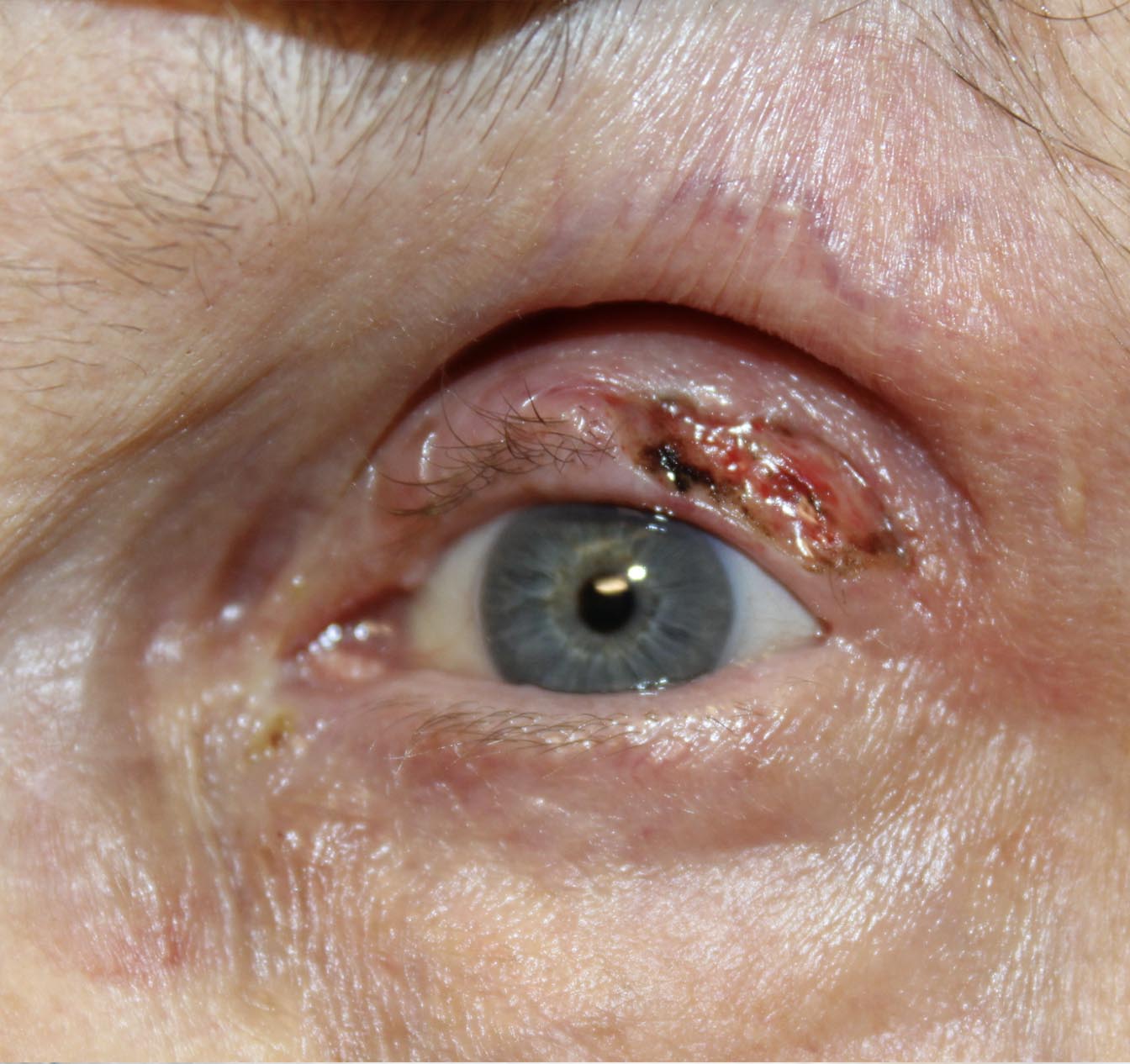 Wedge Reconstruction for Basal Cell Carcinoma of the Upper Eyelid 2 Weeks Post Op Before