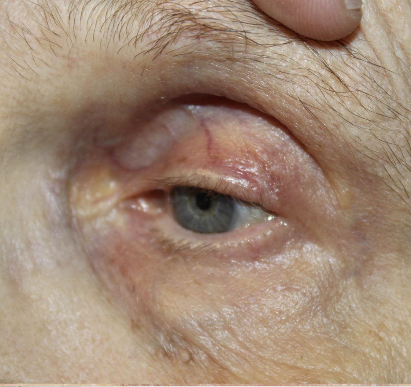 Wedge Reconstruction for Basal Cell Carcinoma of the Upper Eyelid 2 Weeks Post Op After