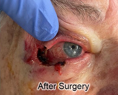 Basal Cell Cancer Involving the Upper and Lower Eyelid: After Surgery