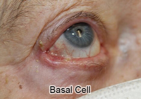 Basal Cell Cancer Involving the Upper and Lower Eyelid: Basal Cell