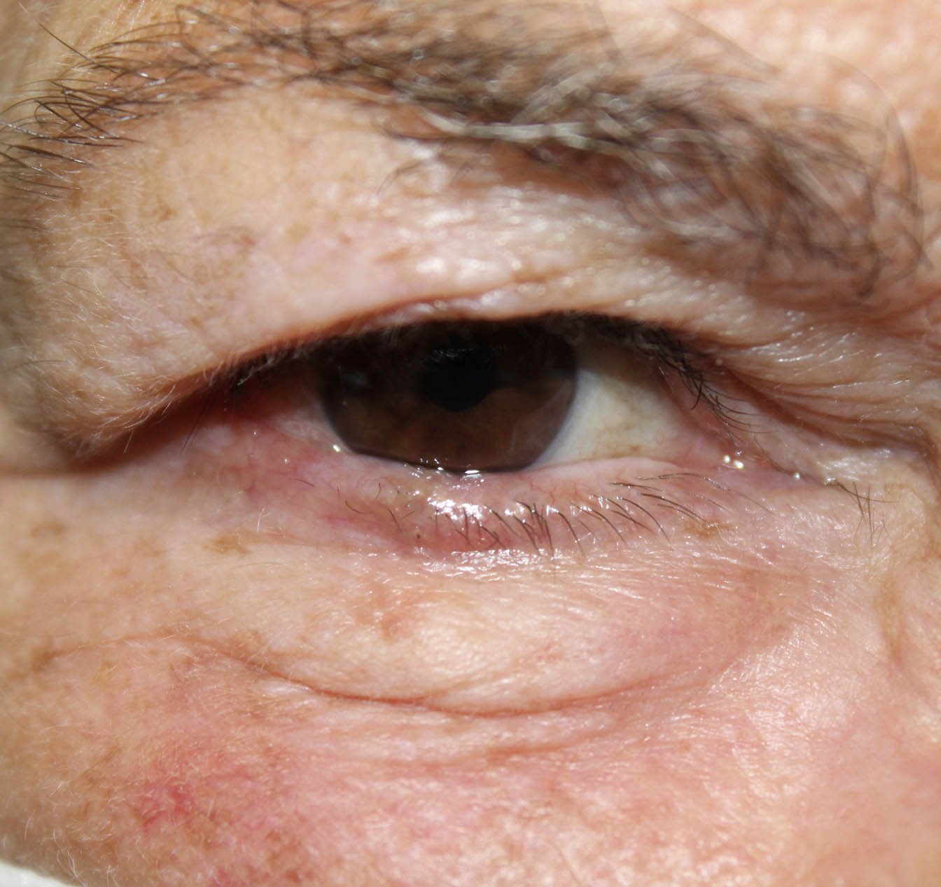 Basal Cell Carcinoma Involving 75% of the Eyelid 2 Months Post Op