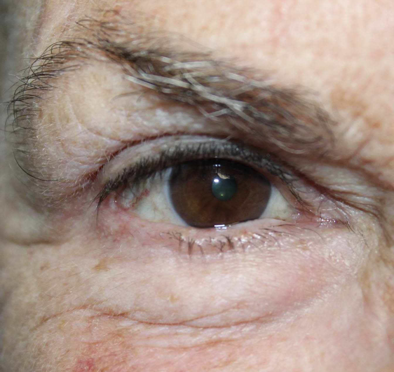 Basal Cell Carcinoma Involving 75% of the Eyelid 12 Months Post Op