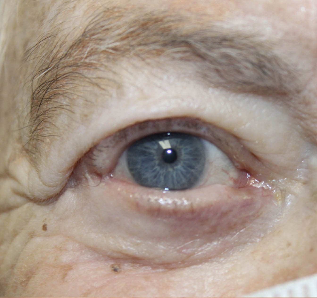 Basal Cell Cancer Involving the Upper and Lower Eyelid After