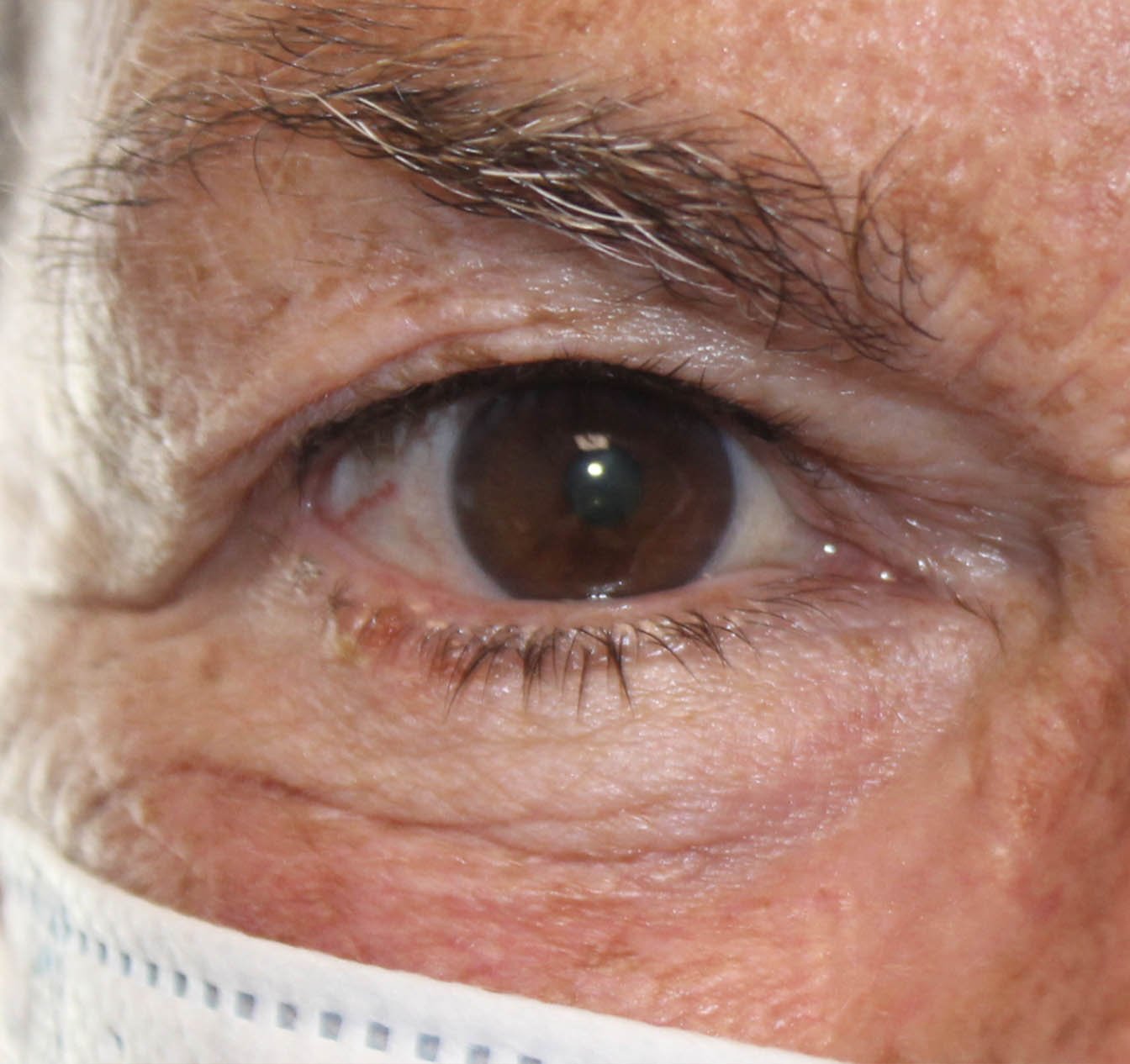 Basal Cell Carcinoma Involving 75% of the Eyelid: Basal Cell