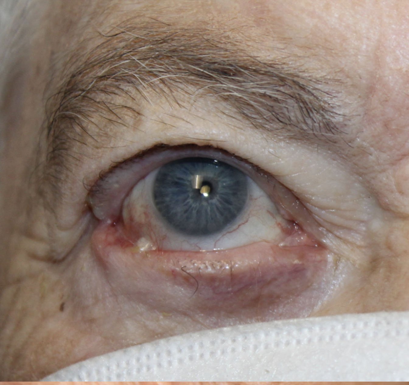 Basal Cell Cancer Involving the Upper and Lower Eyelid Before