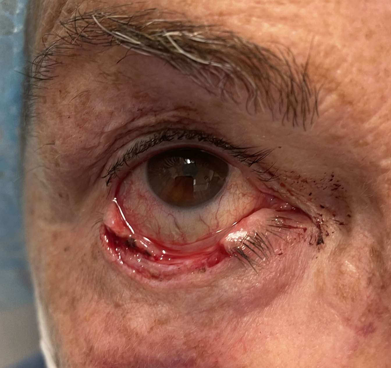 Basal Cell Carcinoma Involving 75% of the Eyelid After Surgery