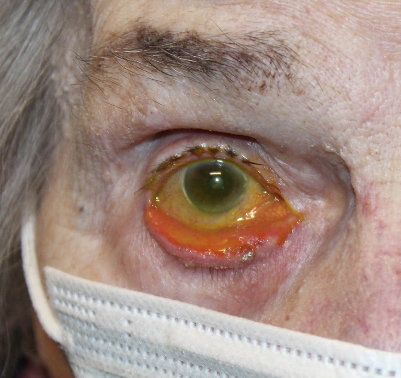 Ectropion Repair with use of Skin Graft Before