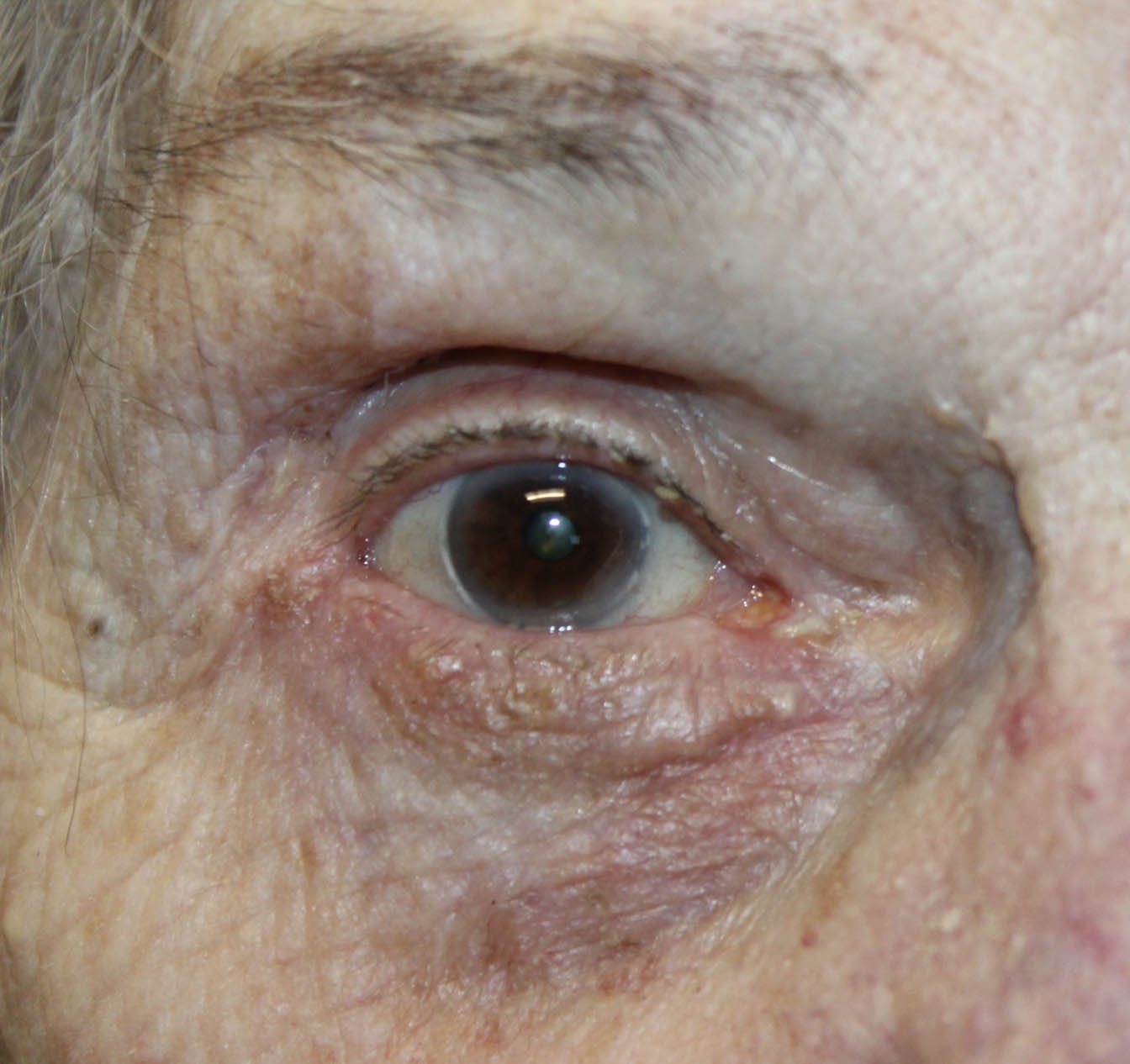 Ectropion Repair with use of Skin Graft After