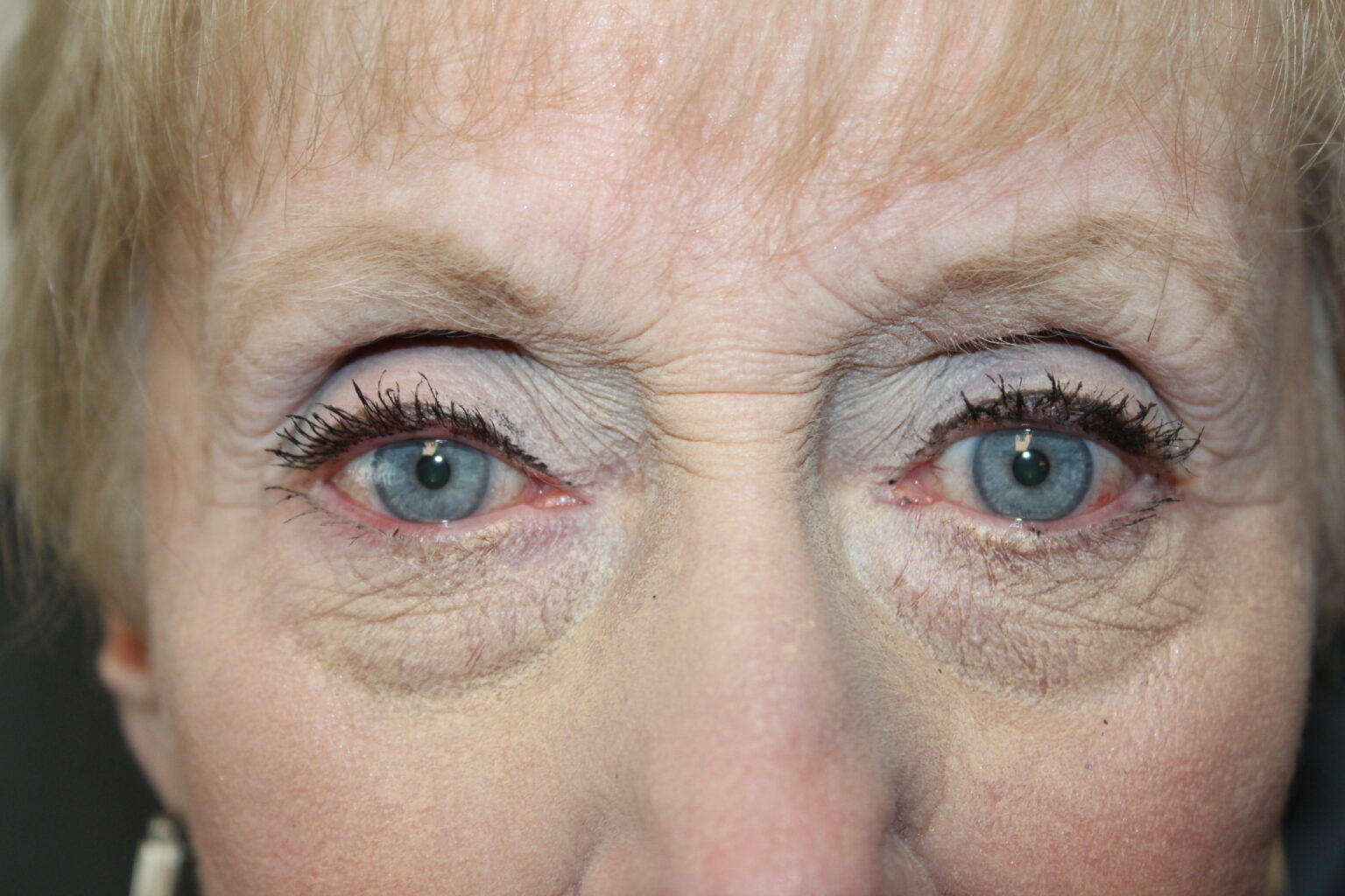 Ptosis Repair After