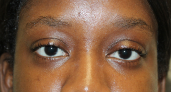 2 Months Following External Ptosis Repair for Congenital Ptosis After