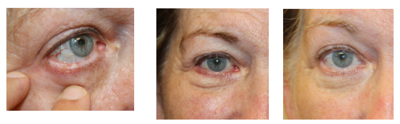 Mohs Excision and Reconstruction Using a Tenzel Flap. After