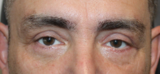 2 Months Following a Direct Brow Ptosis Repair With Upper and Lower Blepharoplasty After