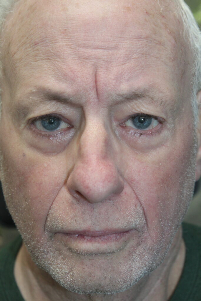 Ptosis Repair After