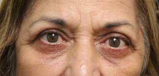 2 Months Following an Upper and Lower Blepharoplasty With Canthopexy and Skin Pinch After