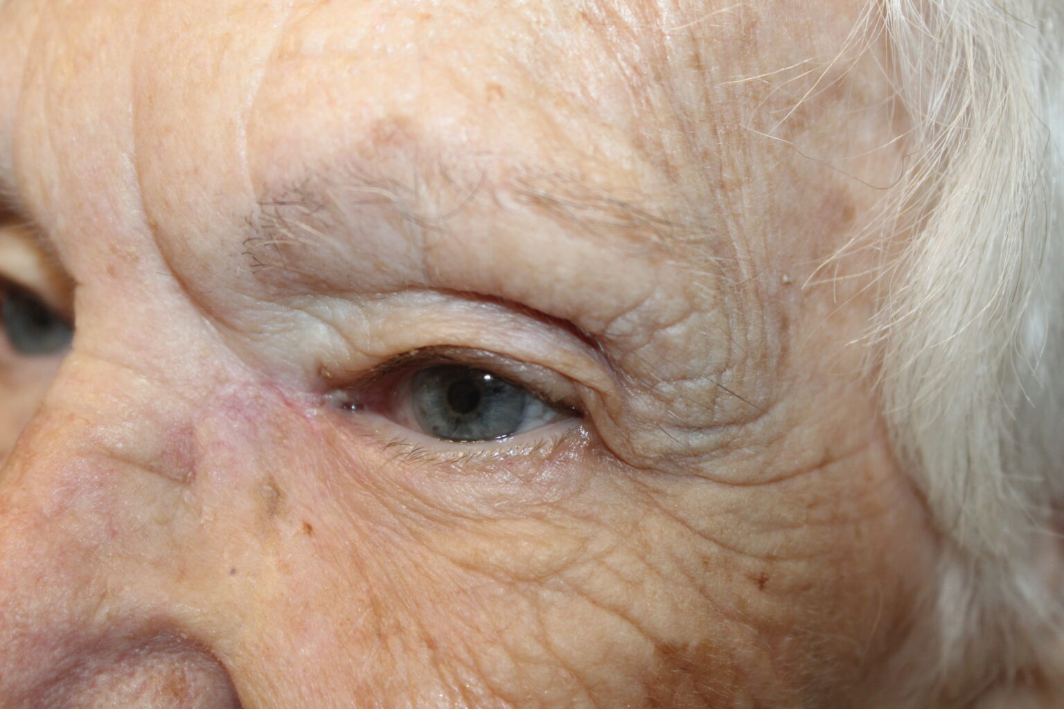 Eyelid Reconstruction After Skin Cancer After