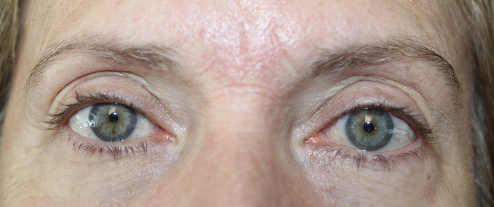 Right Upper Eyelid Ptosis Repair After
