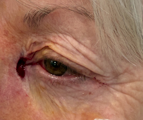 Left Medial Canthal Basal Cell Carcinoma with Mohs Surgery and Reconstruction (Post-Operative Week 1) Mohs
