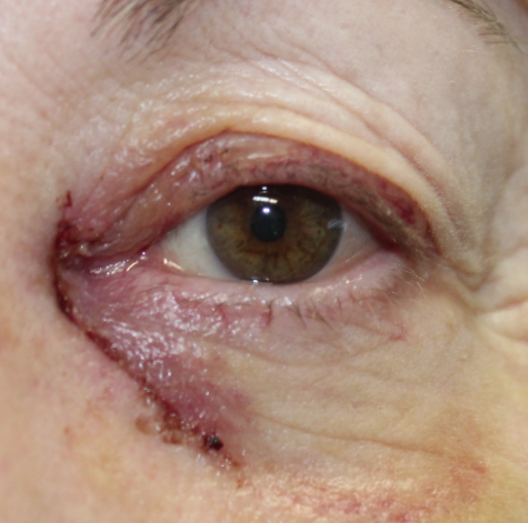 Left Medial Canthal Basal Cell Carcinoma with Mohs Surgery and Reconstruction (Post-Operative Week 1) After (1 Week)