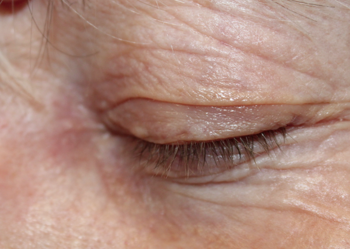 Left Medial Canthal Basal Cell Carcinoma with Mohs Surgery and Reconstruction (Post-Operative Week 1) Before