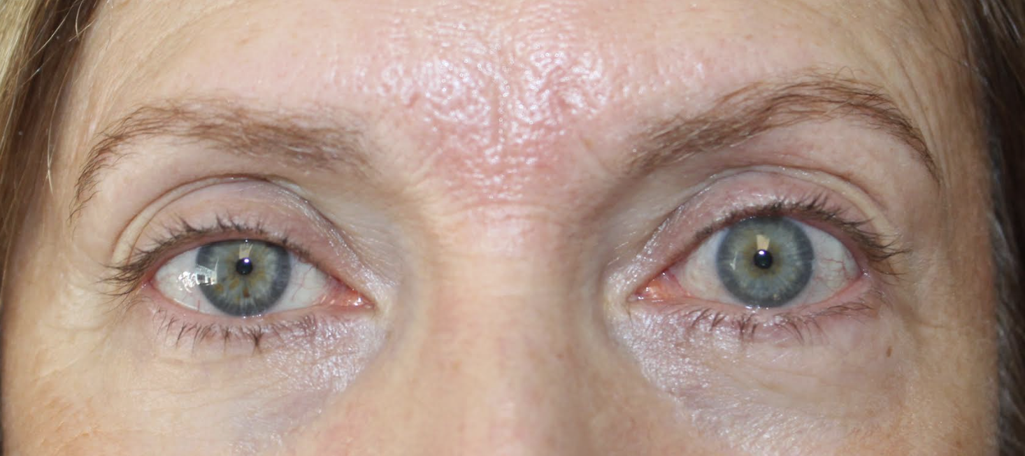 Right Upper Eyelid Ptosis Repair Before