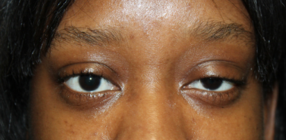 2 Months Following External Ptosis Repair for Congenital Ptosis Before