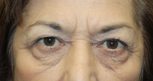 2 Months Following an Upper and Lower Blepharoplasty With Canthopexy and Skin Pinch Before