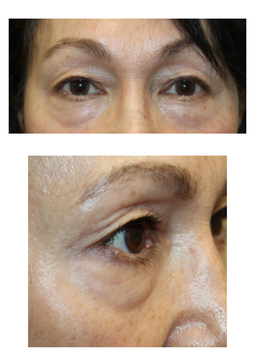 2 Months Following an Upper and Lower Blepharoplasty Before