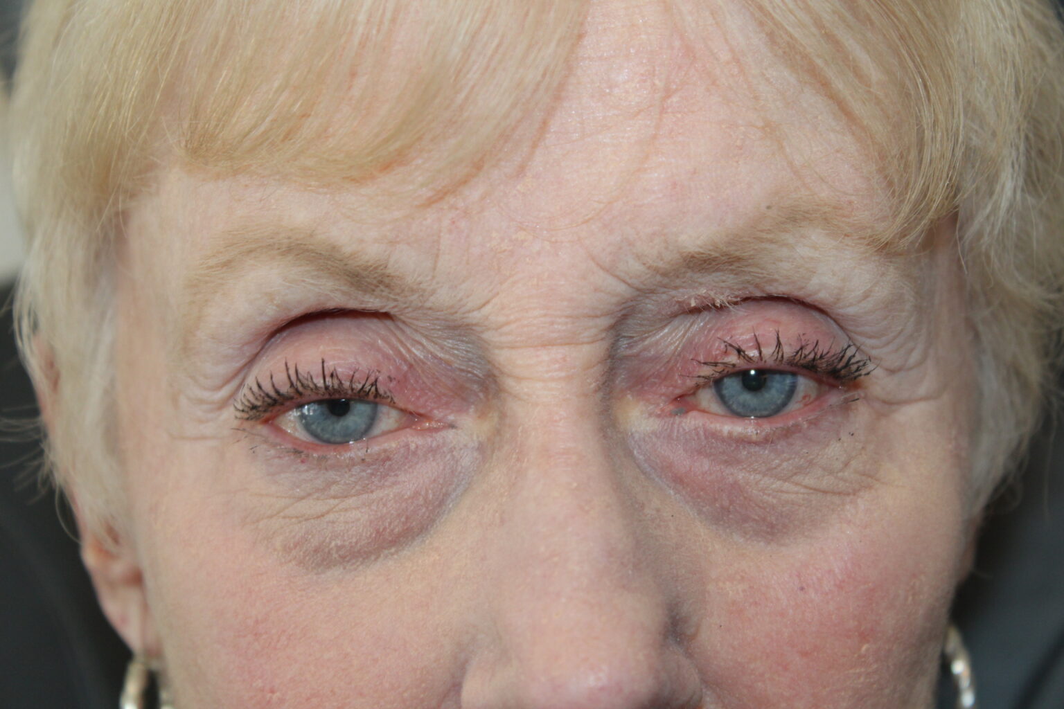 Ptosis Repair Before