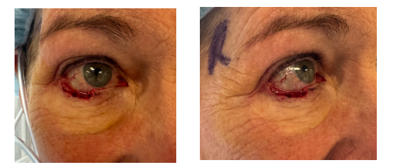 Mohs Excision and Reconstruction Using a Tenzel Flap. Before