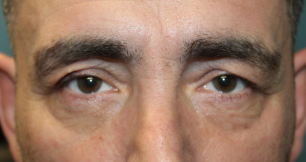 2 Months Following a Direct Brow Ptosis Repair With Upper and Lower Blepharoplasty Before