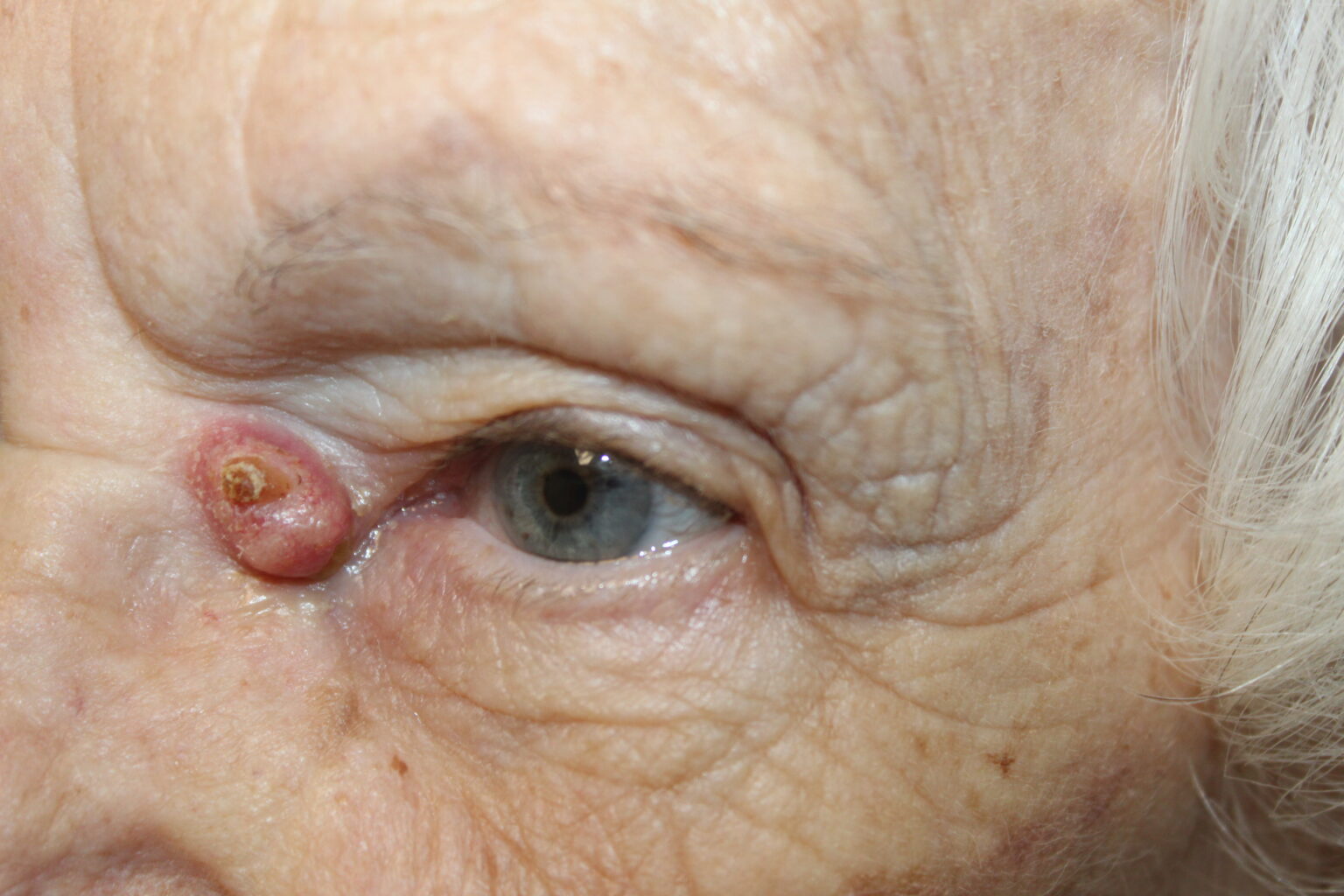 Eyelid Reconstruction After Skin Cancer Before