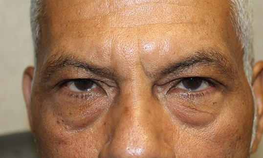Upper & Lower Blepharoplasty Before