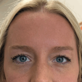 Botox to Glabella, Forehead, and Crows Feet (2 weeks post-procedure) After