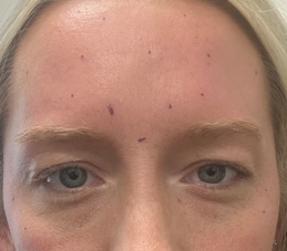 Botox to Glabella, Forehead, and Crows Feet (2 weeks post-procedure) Before