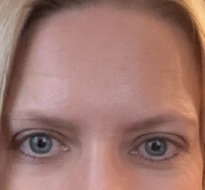 Xeomin to Forehead, Glabella, and Crows Feet After