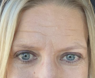 Xeomin to Forehead, Glabella, and Crows Feet Before