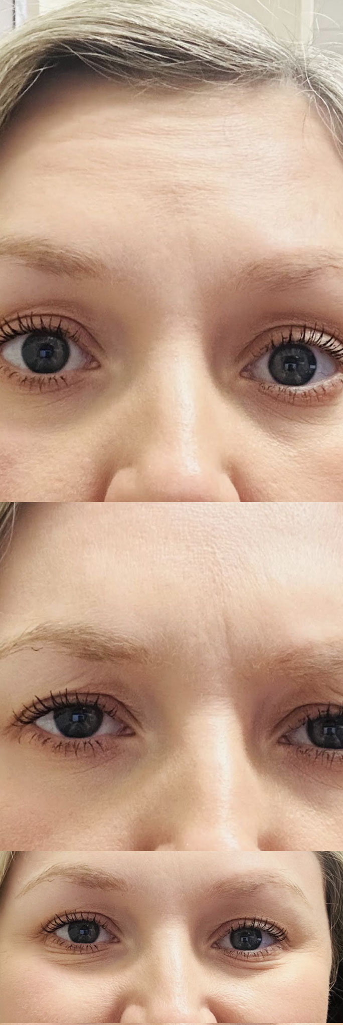 Daxxify Injected to her Crows Feet, Glabella & Forehead After