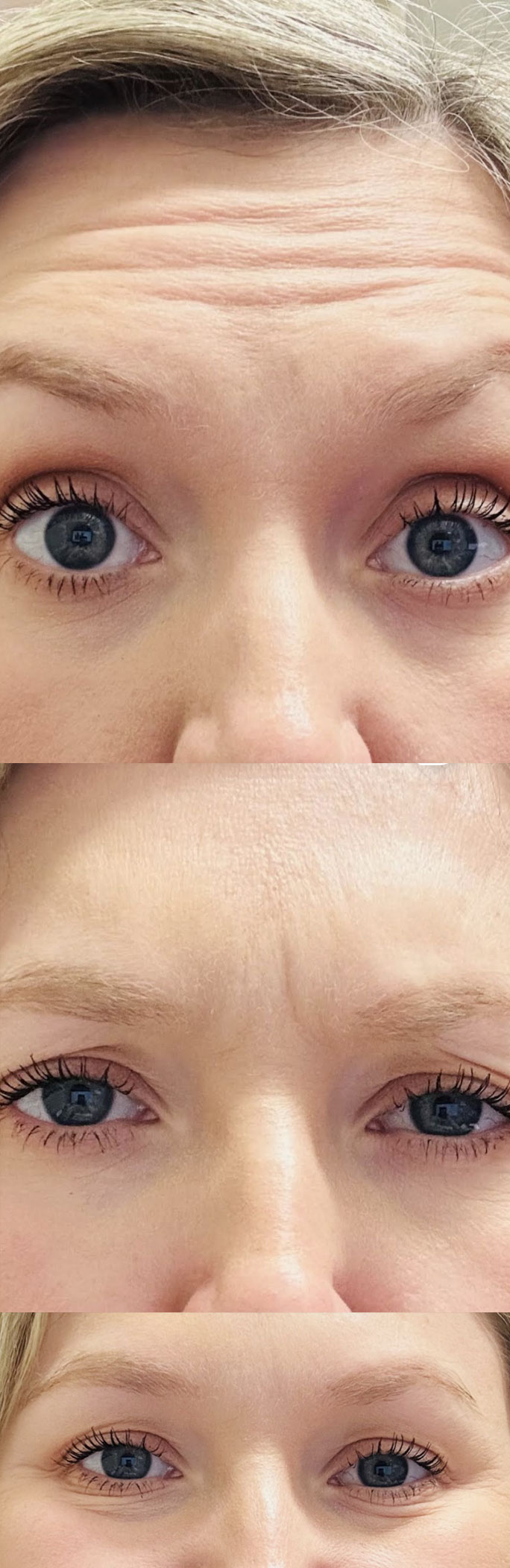 Daxxify Injected to her Crows Feet, Glabella & Forehead Before