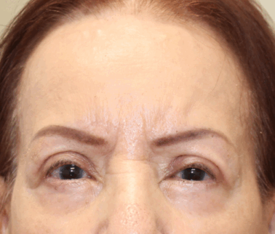 Bilateral Upper Eyelid Ptosis Repair & Bilateral Endoscopic Brow Lift (Post-Operative Month 2) After
