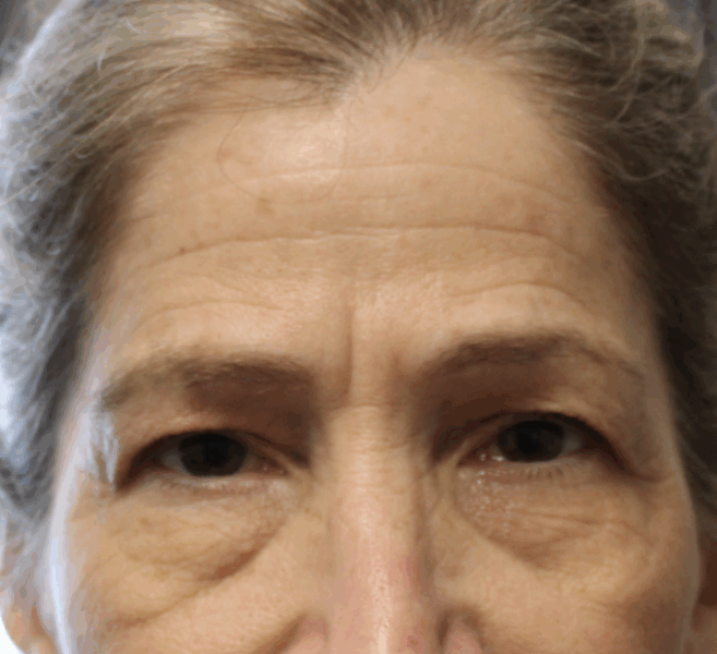 Bilateral Upper Eyelid Ptosis Repair & Bilateral Endoscopic Brow Lift (Post-Operative Month 2) Before
