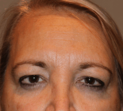 Bilateral Endoscopic Brow Lift Before