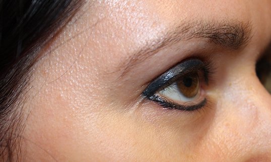 Brow Lift to Refresh Look After