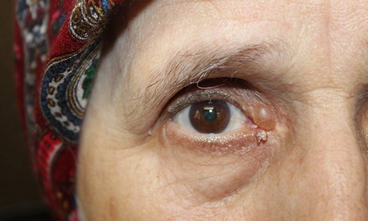 Eyelid Reconstruction After Skin Cancer Before