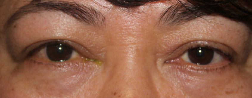 RUL Internal Ptosis Repair (Post-Operative Week 1) After