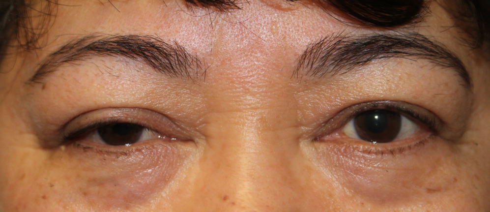 RUL Internal Ptosis Repair (Post-Operative Week 1) Before