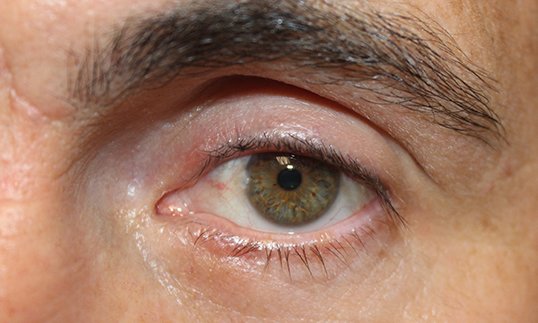 Chalazion Removal Procedure After