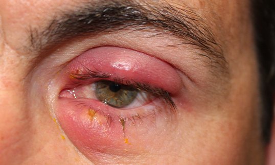 Chalazion Removal Procedure Before